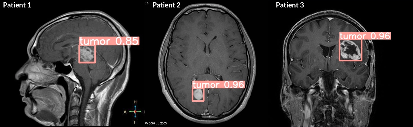 computer vision to detect tumors